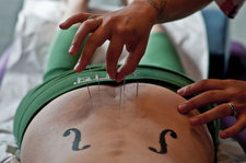 acupuncture needles in back CC
