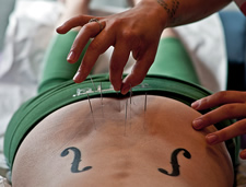 acupuncture needles in back